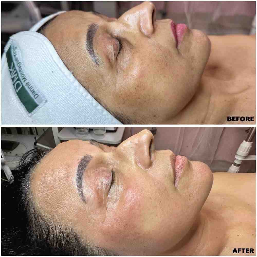 Procell Before Afters PBB 10