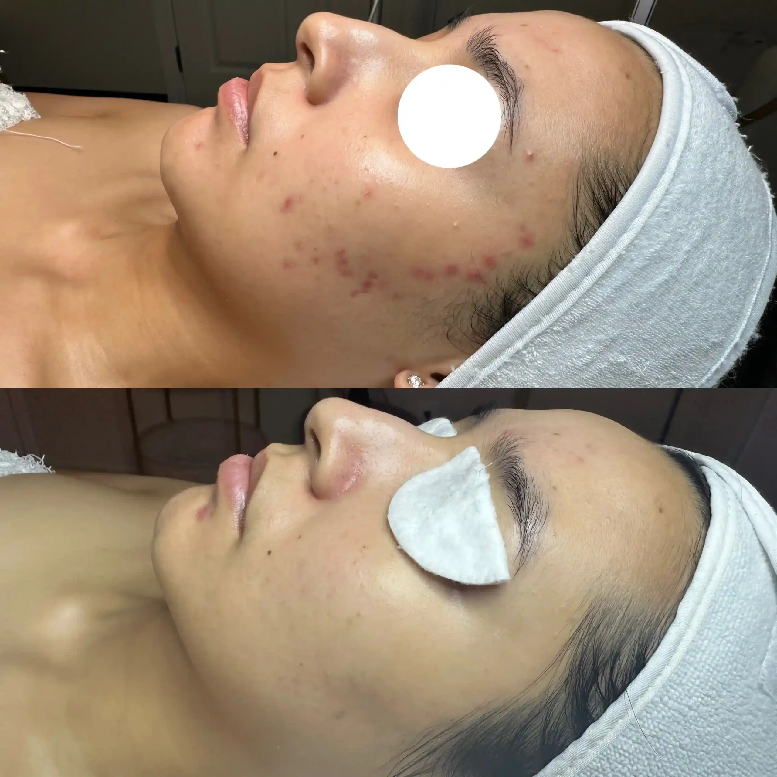Procell Before Afters PBB 5